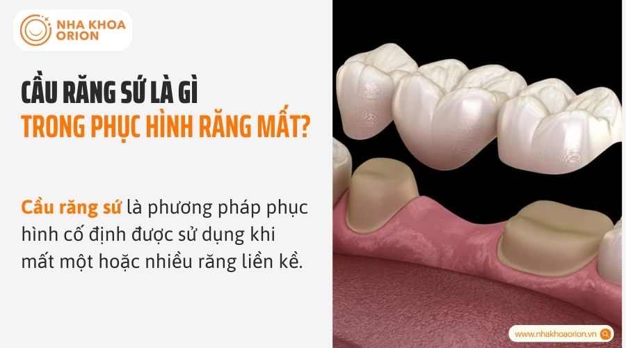 Cầu răng sứ l&agrave; g&igrave; trong phục h&igrave;nh răng mất?