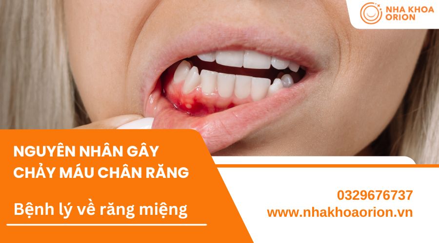 Chảy m&aacute;u do vi&ecirc;m nướu răng l&agrave; t&igrave;nh trạng nhiều người gặp phải nhất