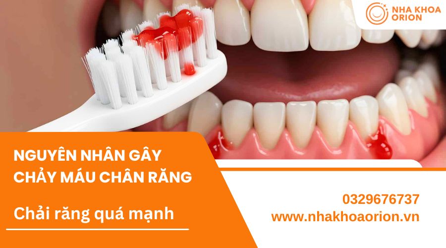 Chảy m&aacute;u nướu do chải răng qu&aacute; mạnh
