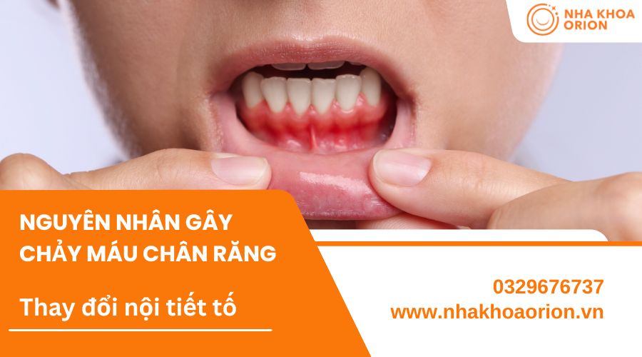 Chảy m&aacute;u nướu răng do thay đổi nội tiết tố