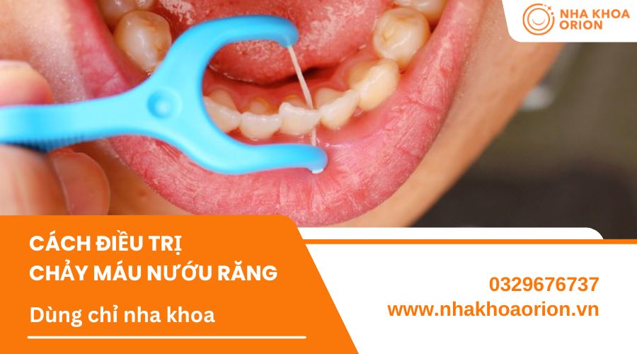 Sử dụng chỉ nha khoa để tăng hiệu quả l&agrave;m sạch răng miệng