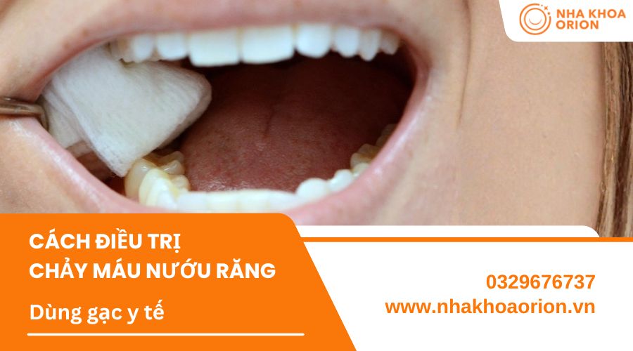 D&ugrave;ng gạc y tế c&oacute; thấm nước lạnh gi&uacute;p giảm chảy m&aacute;u nướu