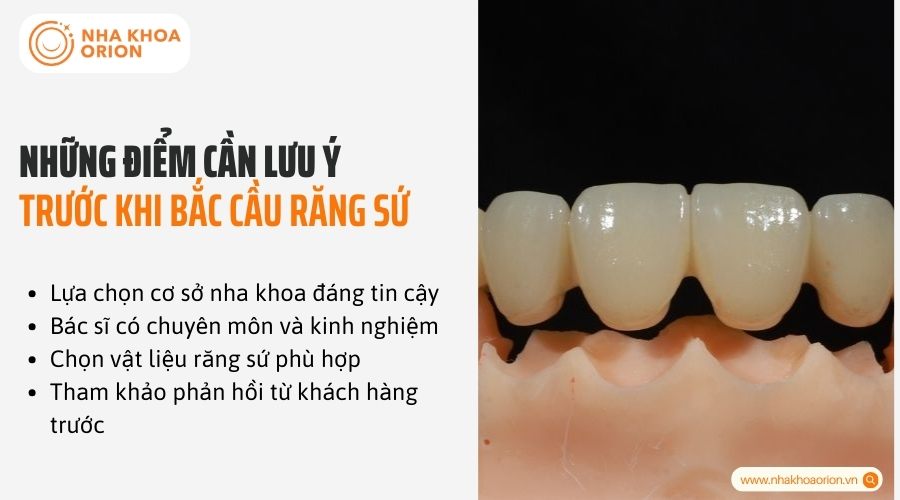 Những điểm cần lưu &yacute; trước khi bắc cầu răng sứ