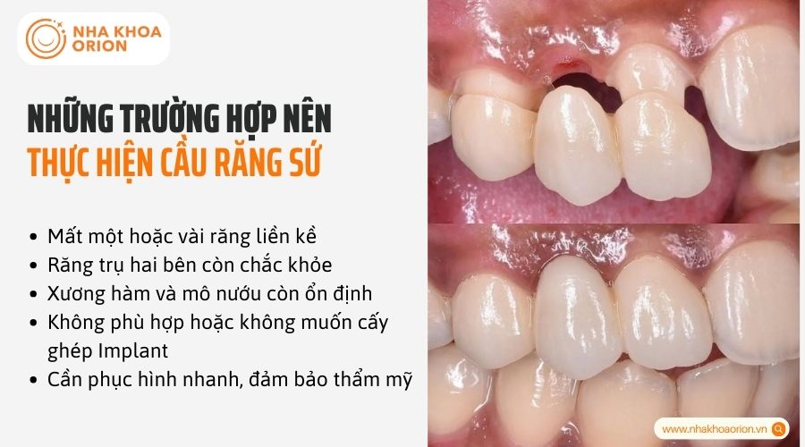 Những trường hợp n&ecirc;n thực hiện cầu răng sứ