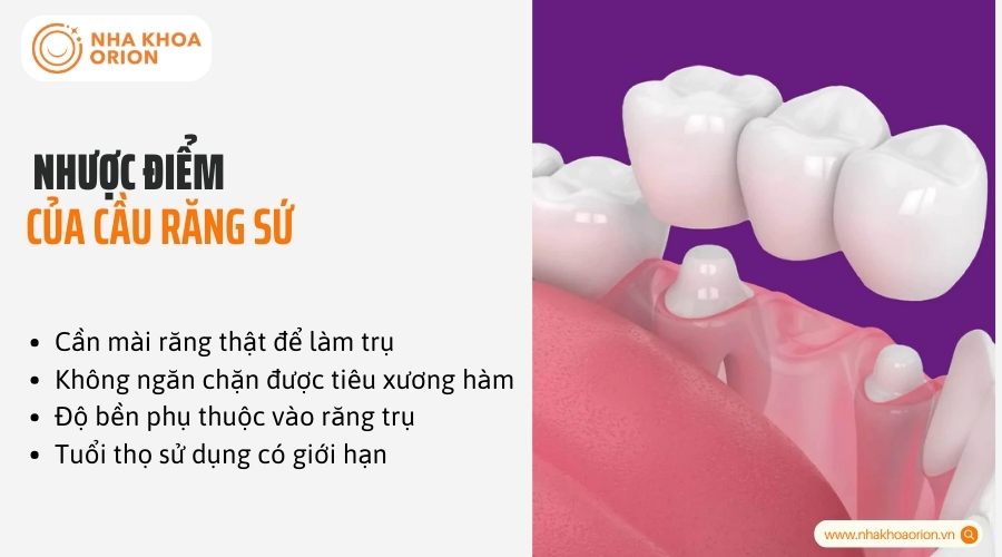 Nhược điểm của cầu răng sứ