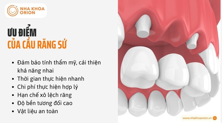 Ưu điểm của cầu răng sứ
