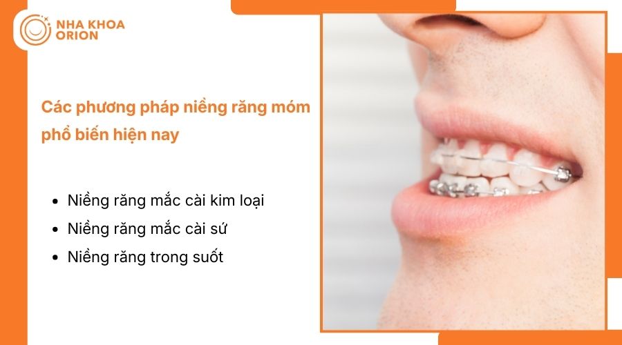 Các phương pháp niềng răng móm phổ biến hiện nay
