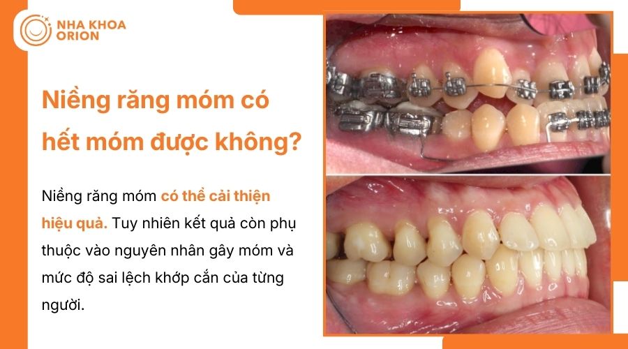 Niềng răng có thể giúp cải thiện tình trạng móm hiệu quả