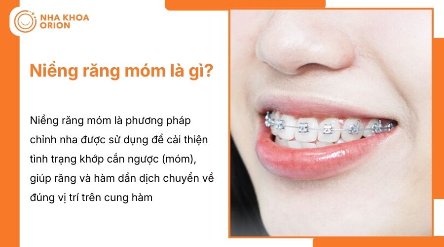 Niềng răng móm giúp cải thiện khớp cắn ngược và cân đối khuôn mặt