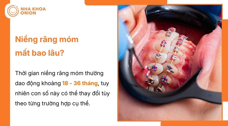 Thời gian niềng răng móm trung bình khoảng 18 - 36 tháng