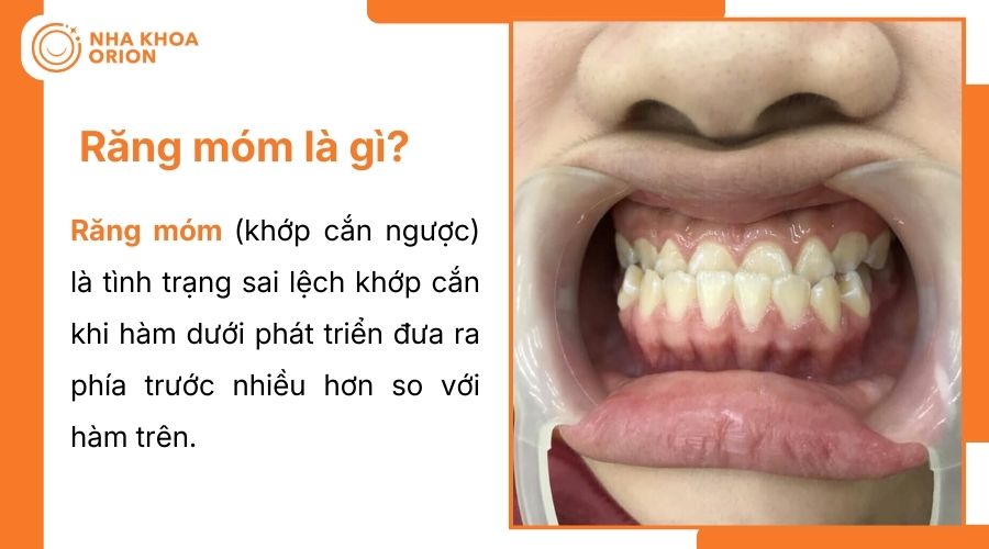 Tìm hiểu răng móm là gì