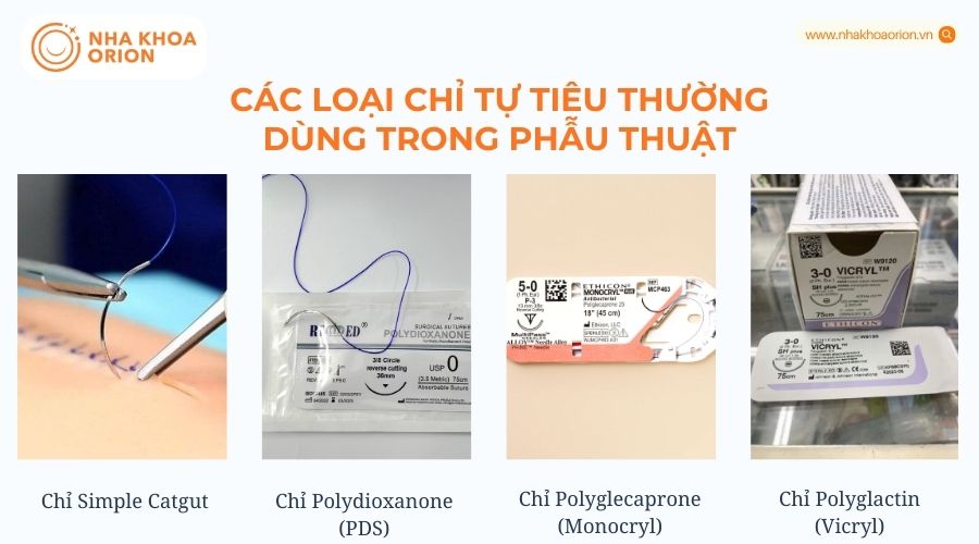 Các loại chỉ tự tiêu trong phẫu thuật