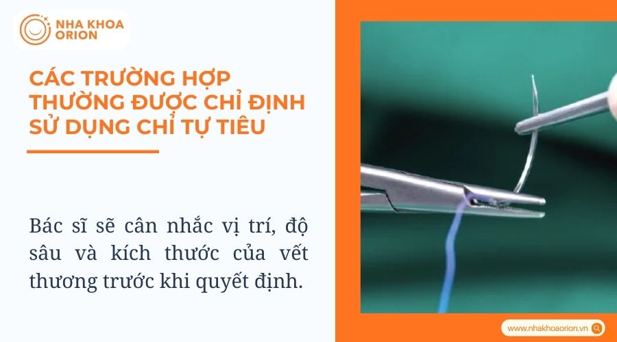 Các trường hợp thường được chỉ định sử dụng chỉ tự tiêu