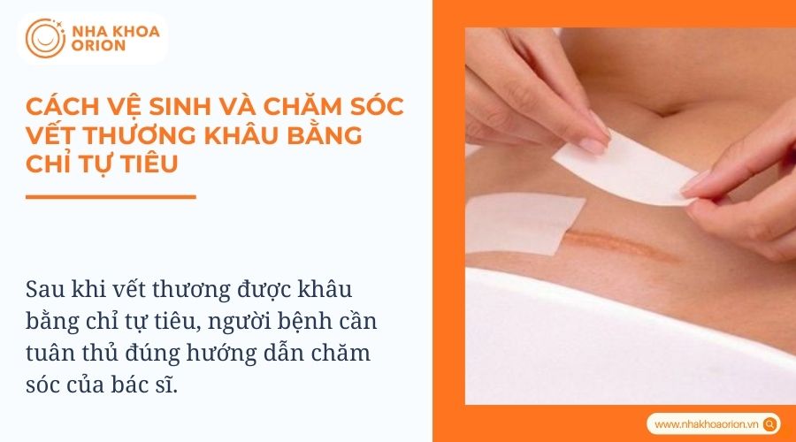 Cách vệ sinh và chăm sóc vết thương khâu bằng chỉ tự tiêu