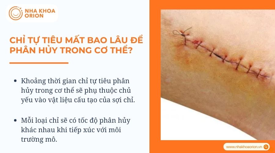 Chỉ tự tiêu sau bao nhiêu ngày?