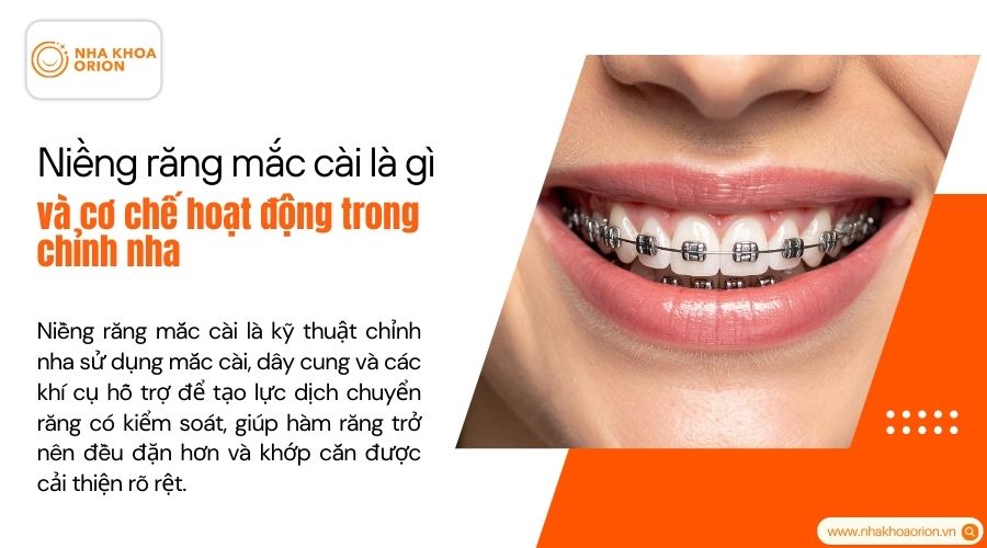 T&igrave;m hiểu niềng răng mắc c&agrave;i l&agrave; g&igrave;