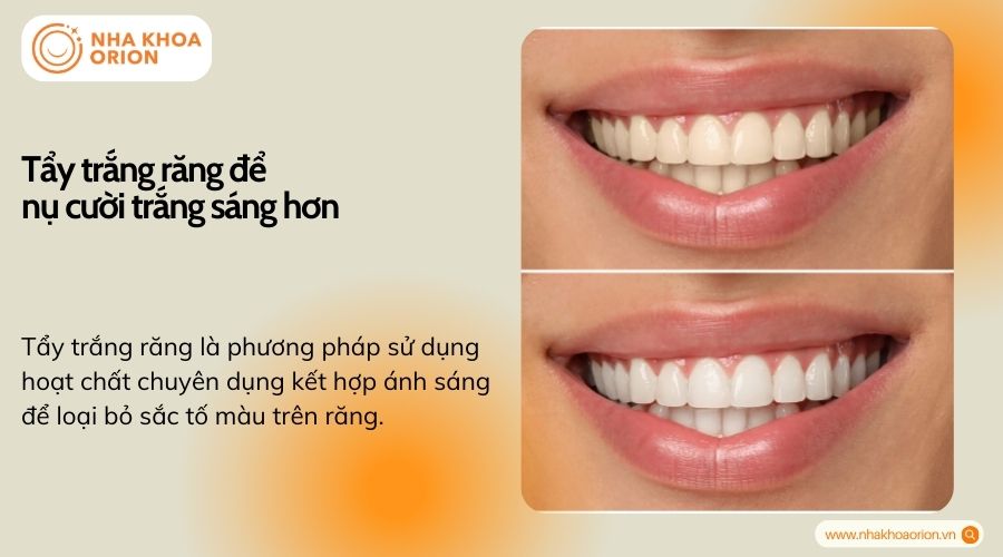 Tẩy trắng răng để nụ cười trắng s&aacute;ng hơn