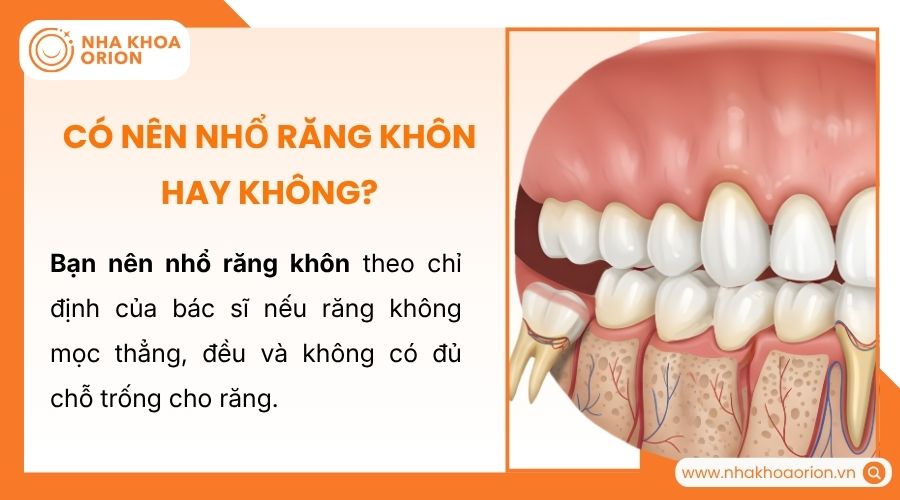 Bạn nên nhổ răng khôn theo chỉ định của bác sĩ