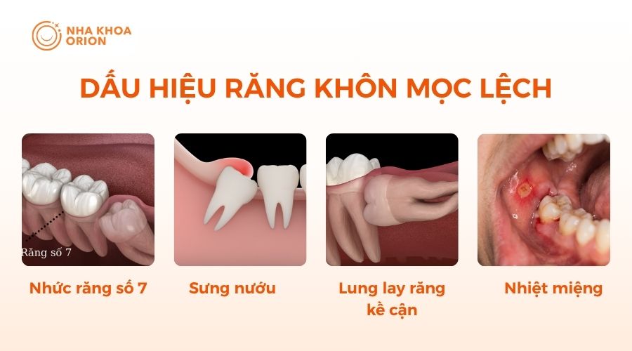 Những dấu hiệu cho thấy răng kh&ocirc;n đang mọc lệch