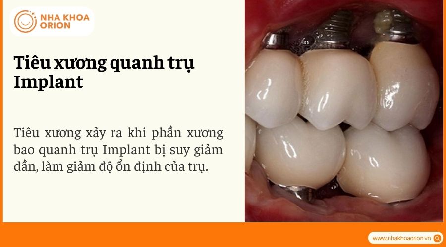 Ti&ecirc;u xương quanh trụ Implant