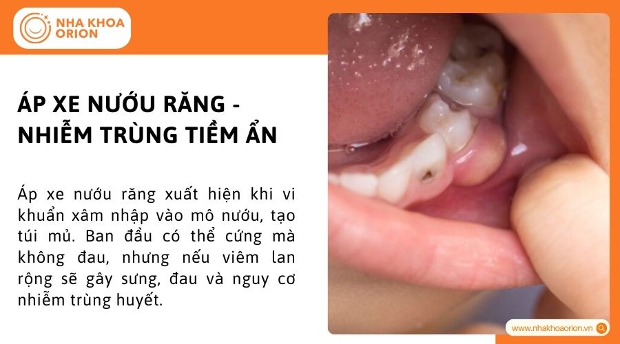 &Aacute;p xe nướu răng - Nhiễm tr&ugrave;ng tiềm ẩn