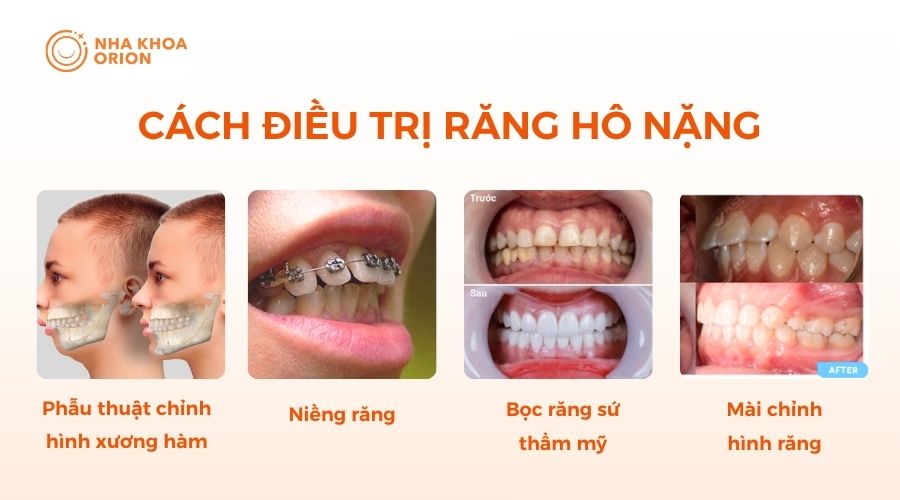 C&aacute;ch chữa răng h&ocirc; nặng hiệu quả