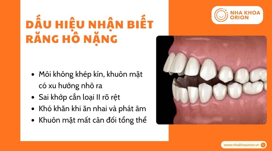 Người bị răng h&ocirc; nặng thường kh&oacute; kh&eacute;p k&iacute;n m&ocirc;i v&agrave; c&oacute; răng cửa ch&igrave;a ra trước