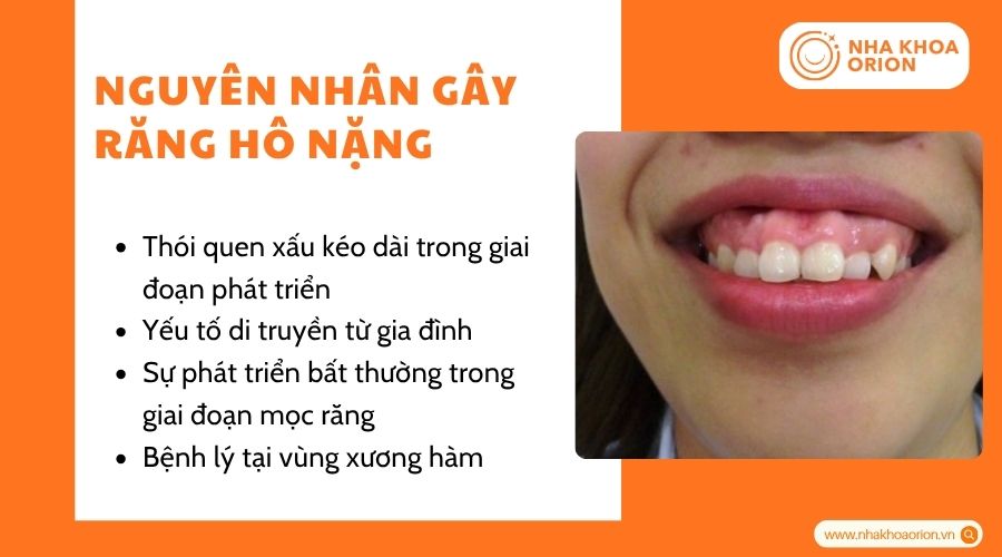 Răng h&ocirc; nặng thường do yếu tố di truyền v&agrave; c&aacute;c th&oacute;i quen xấu k&eacute;o d&agrave;i