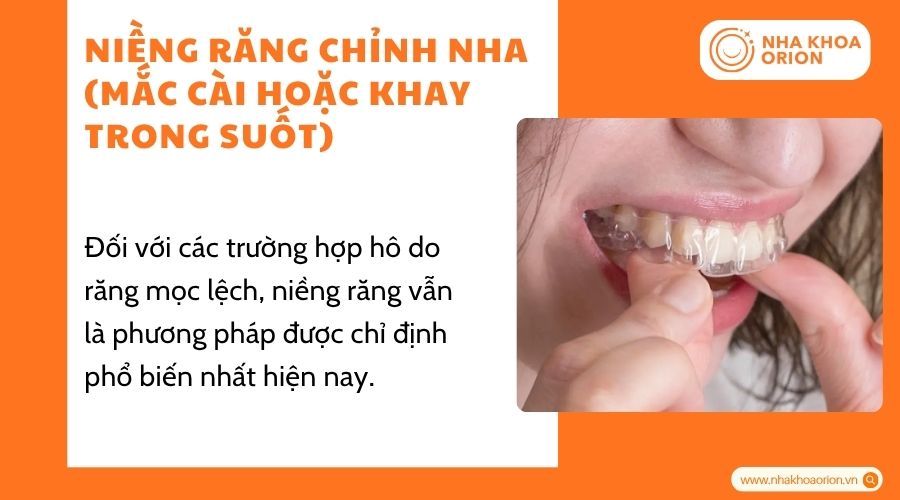 Niềng răng l&agrave; phương ph&aacute;p h&agrave;ng đầu được nha sĩ khuyến nghị