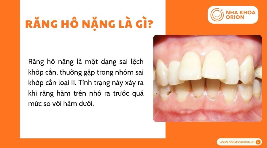 Răng h&ocirc; nặng thuộc nh&oacute;m sai lệch khớp cắn loại II