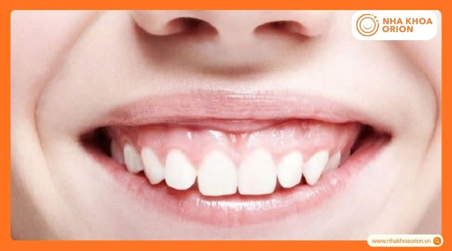 Răng h&agrave;m tr&ecirc;n nh&ocirc; xa h&agrave;m dưới l&agrave;m răng h&ocirc; nặng