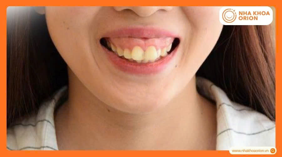 Răng h&agrave;m tr&ecirc;n ch&igrave;a ra qu&aacute; nhiều g&acirc;y ra cười hở lợi