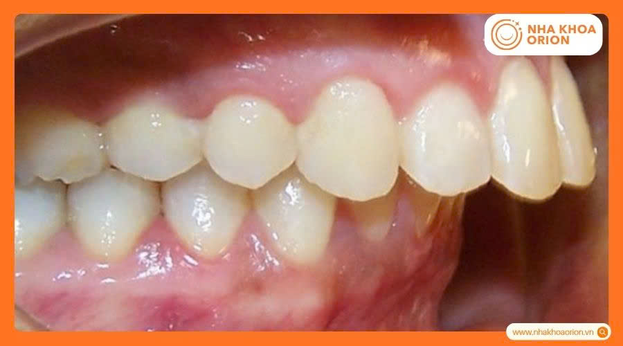 Răng h&ocirc; nặng khiến h&agrave;m tr&ecirc;n nh&ocirc; ra nhiều l&agrave;m lệch khớp cắn
