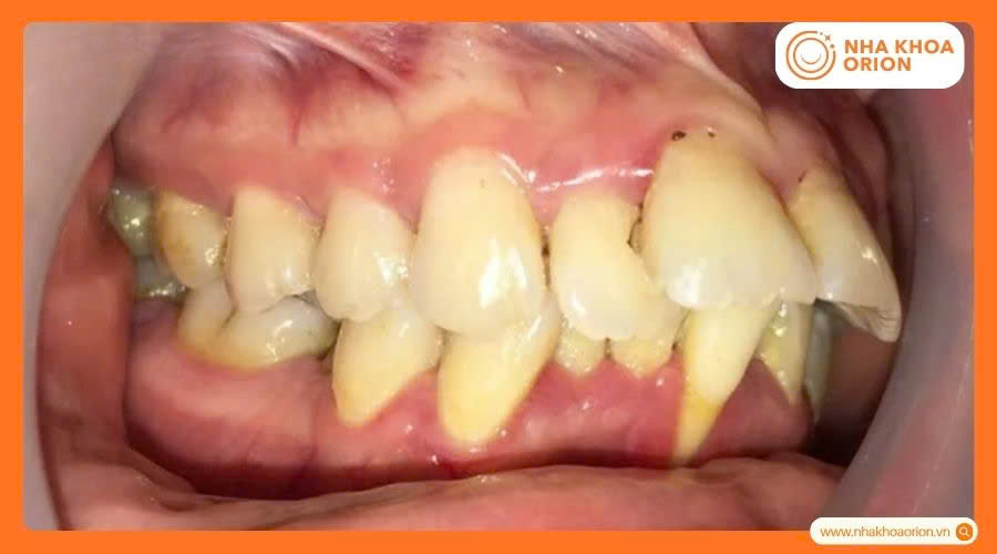 T&igrave;nh trạng răng h&ocirc; nặng v&agrave; bị x&ocirc; lệch