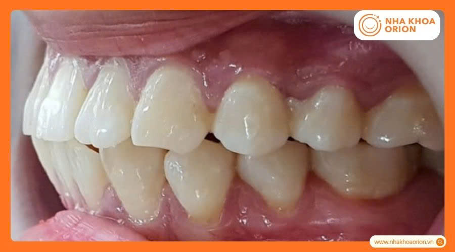 Răng h&ocirc; cả hai h&agrave;m khiến răng cửa ch&igrave;a ra trước