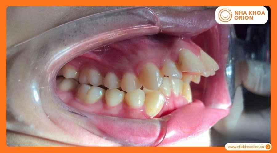 Răng h&agrave;m tr&ecirc;n h&ocirc; nghi&ecirc;m trọng với răng cửa ch&igrave;a ra trước 45 độ