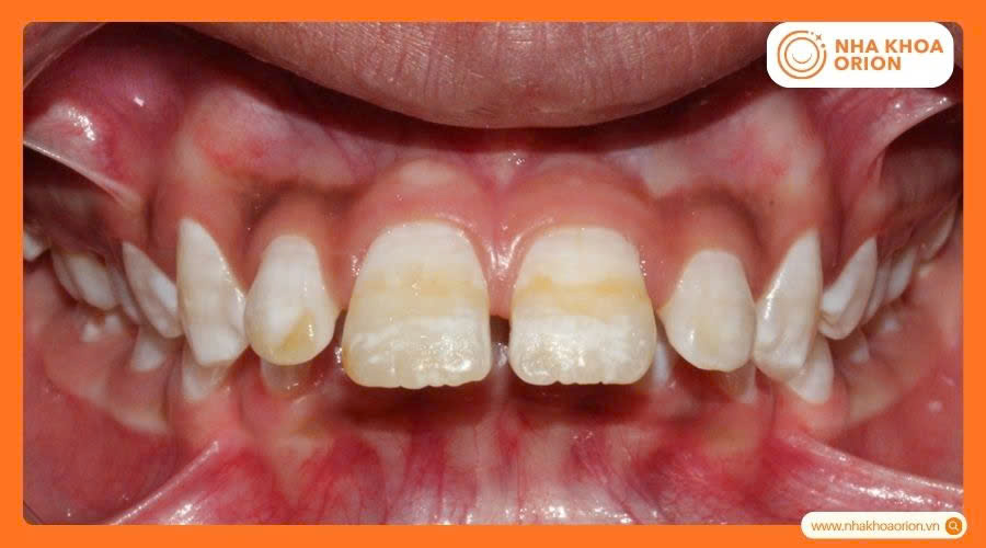Răng h&ocirc; nặng k&egrave;m theo t&igrave;nh trạng m&ograve;n men răng&nbsp;