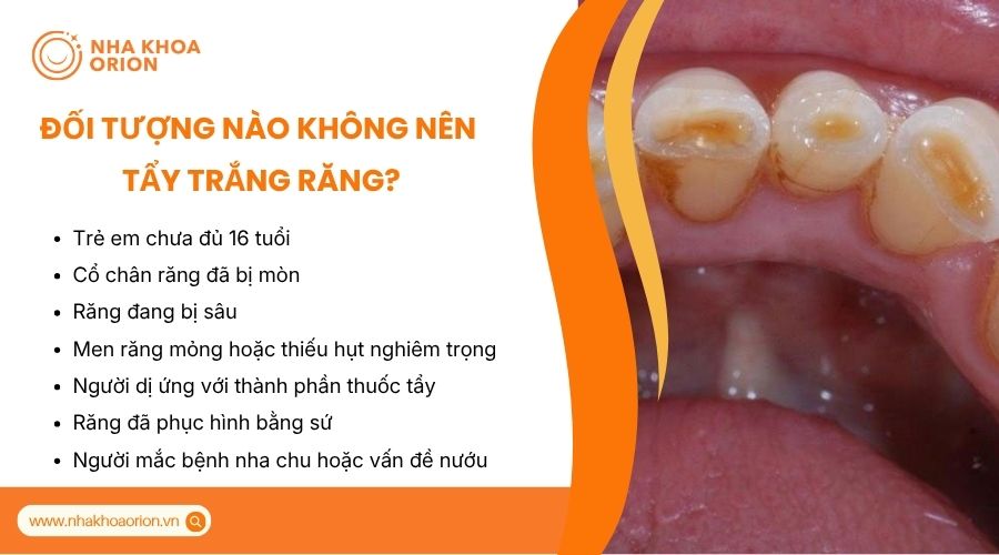 Tẩy trắng răng cần được chỉ định sau khi thăm kh&aacute;m chuy&ecirc;n khoa