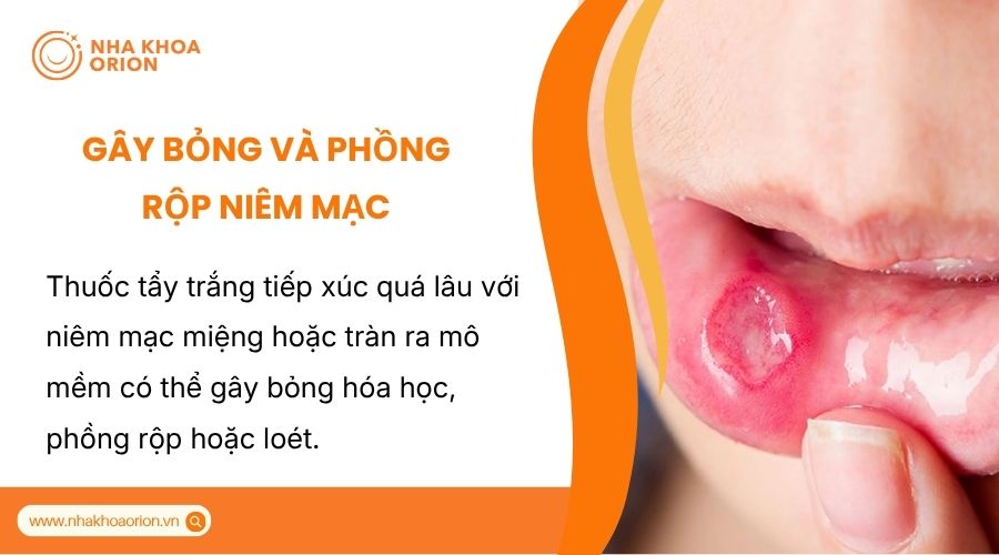 Thuốc tẩy trắng tiếp x&uacute;c l&acirc;u dễ g&acirc;y bỏng v&agrave; lo&eacute;t ni&ecirc;m mạc miệng