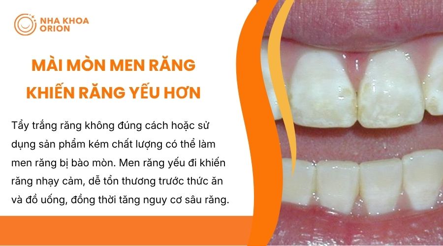 Tẩy trắng sai c&aacute;ch l&agrave;m m&ograve;n men răng, khiến răng nhạy cảm v&agrave; yếu