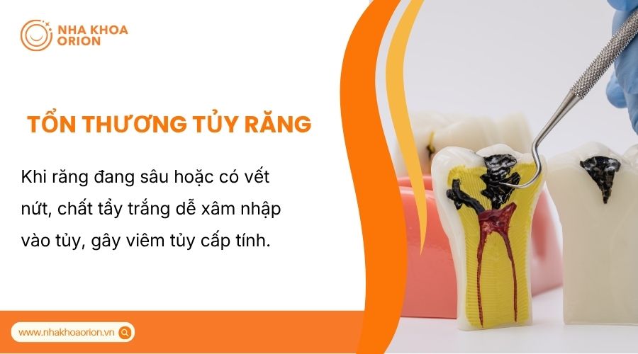 Răng s&acirc;u hoặc nứt dễ bị vi&ecirc;m tủy khi tẩy trắng