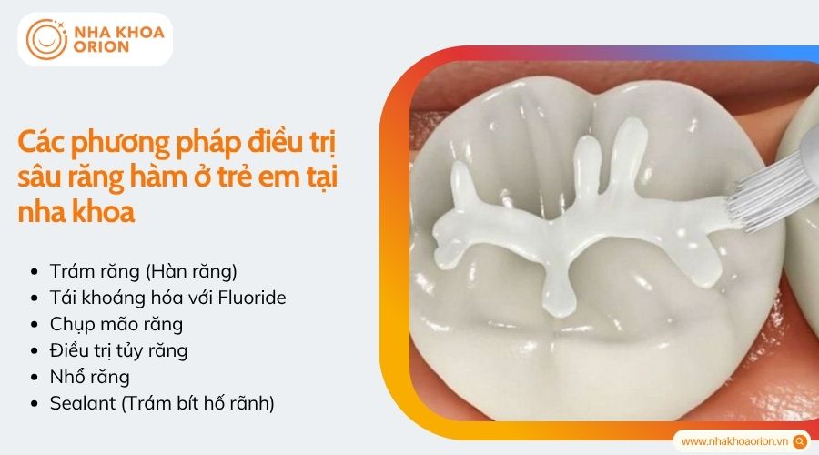 C&aacute;c phương ph&aacute;p điều trị s&acirc;u răng h&agrave;m ở trẻ em tại nha khoa