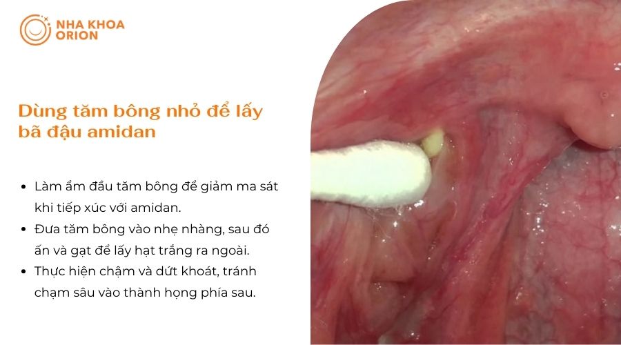 D&ugrave;ng tăm b&ocirc;ng c&oacute; thể lấy sỏi nhanh nhưng dễ g&acirc;y tổn thương nếu thao t&aacute;c sai