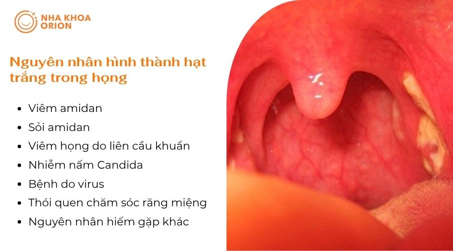 Nguy&ecirc;n nh&acirc;n h&igrave;nh th&agrave;nh hạt trắng trong họng