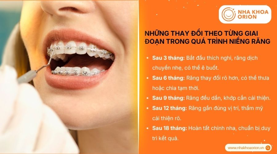 Những thay đổi theo từng giai đoạn trong qu&aacute; tr&igrave;nh niềng răng