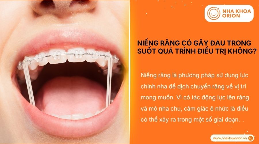 Trong suốt qu&agrave; tr&igrave;nh niềng răng c&oacute; đau kh&ocirc;ng?