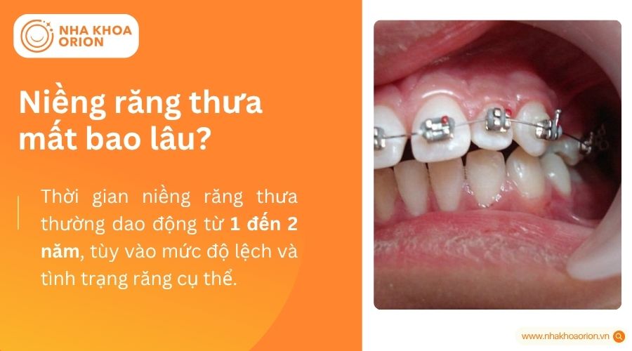 Niềng răng thưa mất bao lâu?