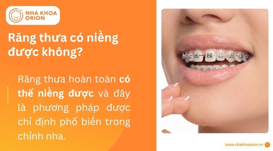 Răng thưa có niềng được không?