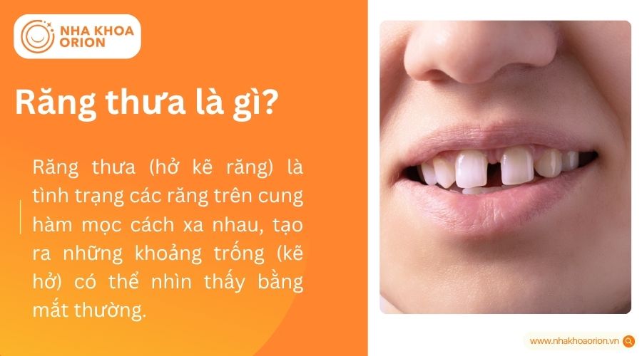 Răng thưa là gì?