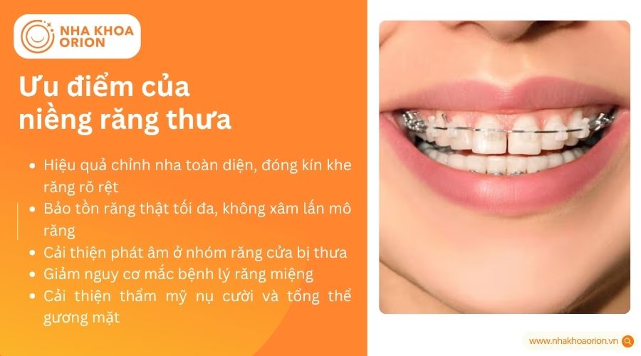 Ưu điểm của niềng răng thưa